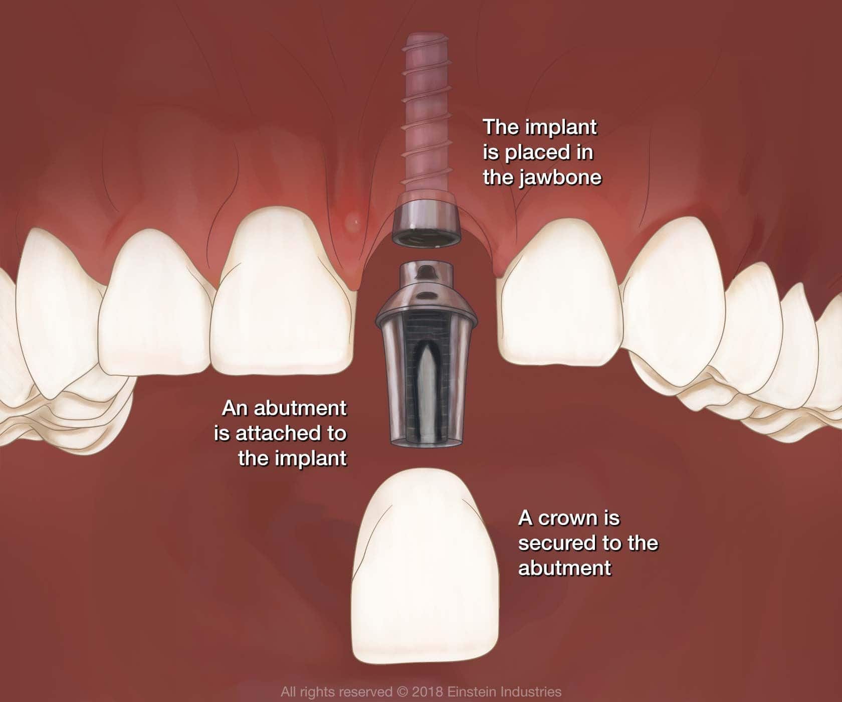 dental implants in fort worth tx