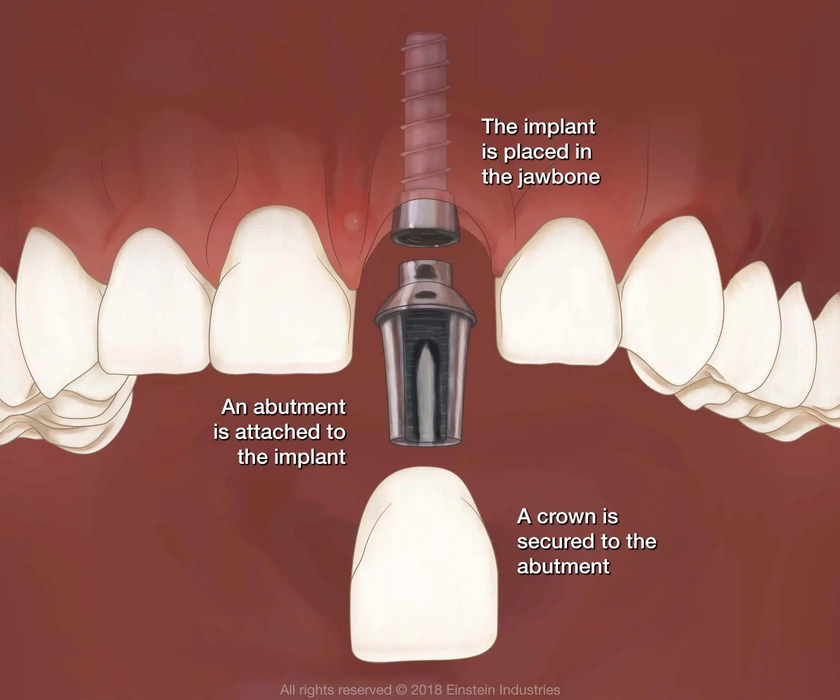 dental implants in fort worth tx