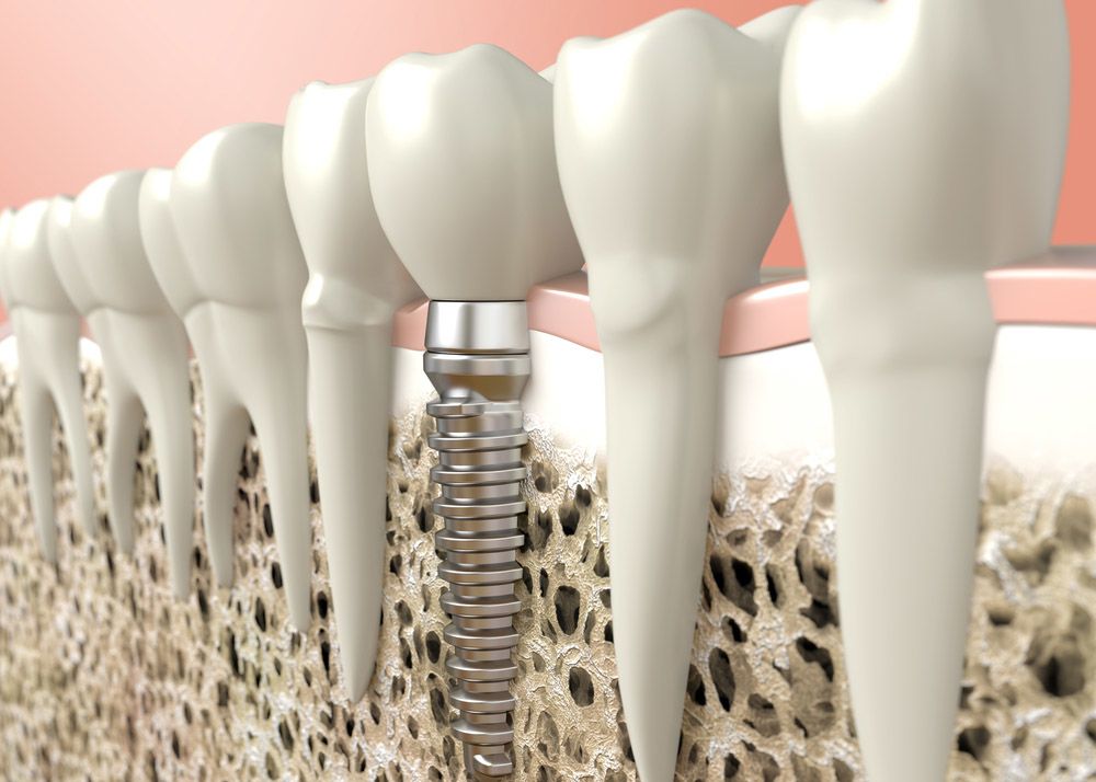 can I get dental implants if I have an autoimmune disease