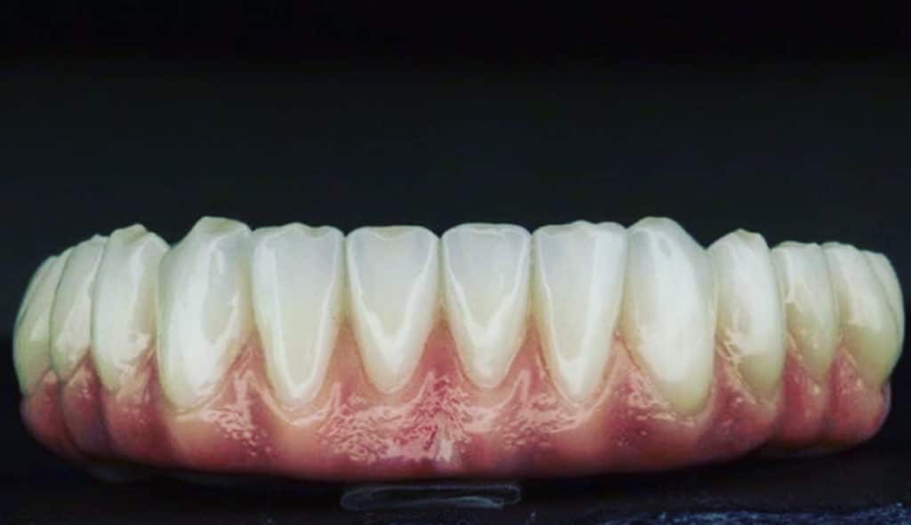 Zirconia Dental Implant Bridge