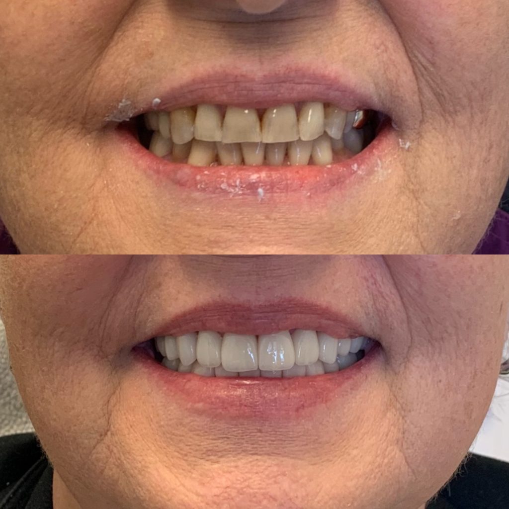porcelain veneers