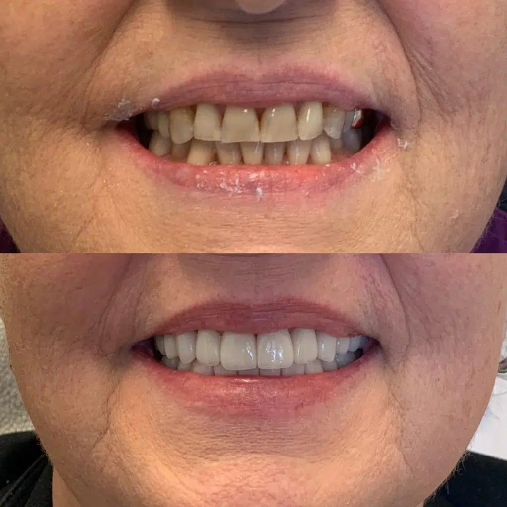 porcelain veneers