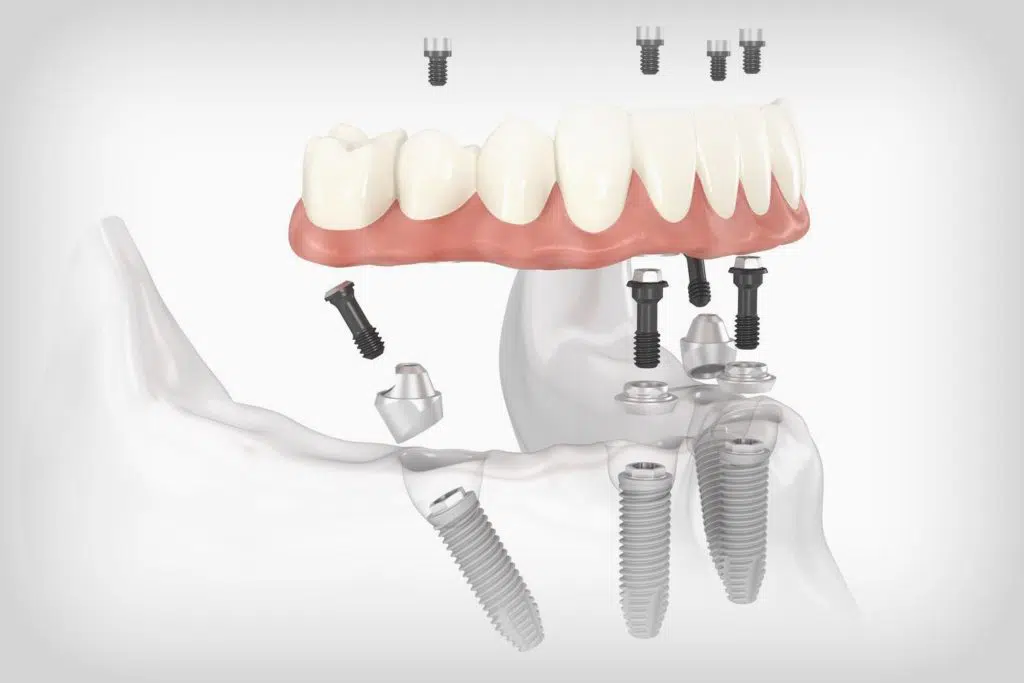 all-on-4-fort-worth-dental-implants