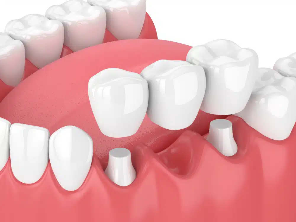 dental bridge in fort worth, tx