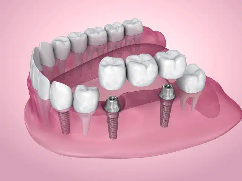 Example of an implant supported bridge in Fort Worth, TX