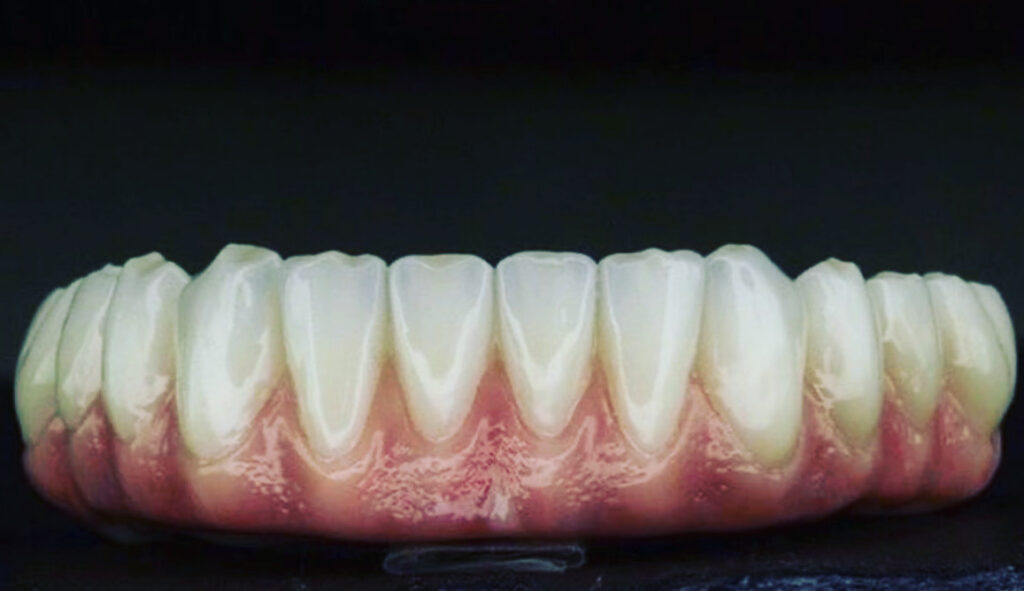 Zirconia dental implant bridge