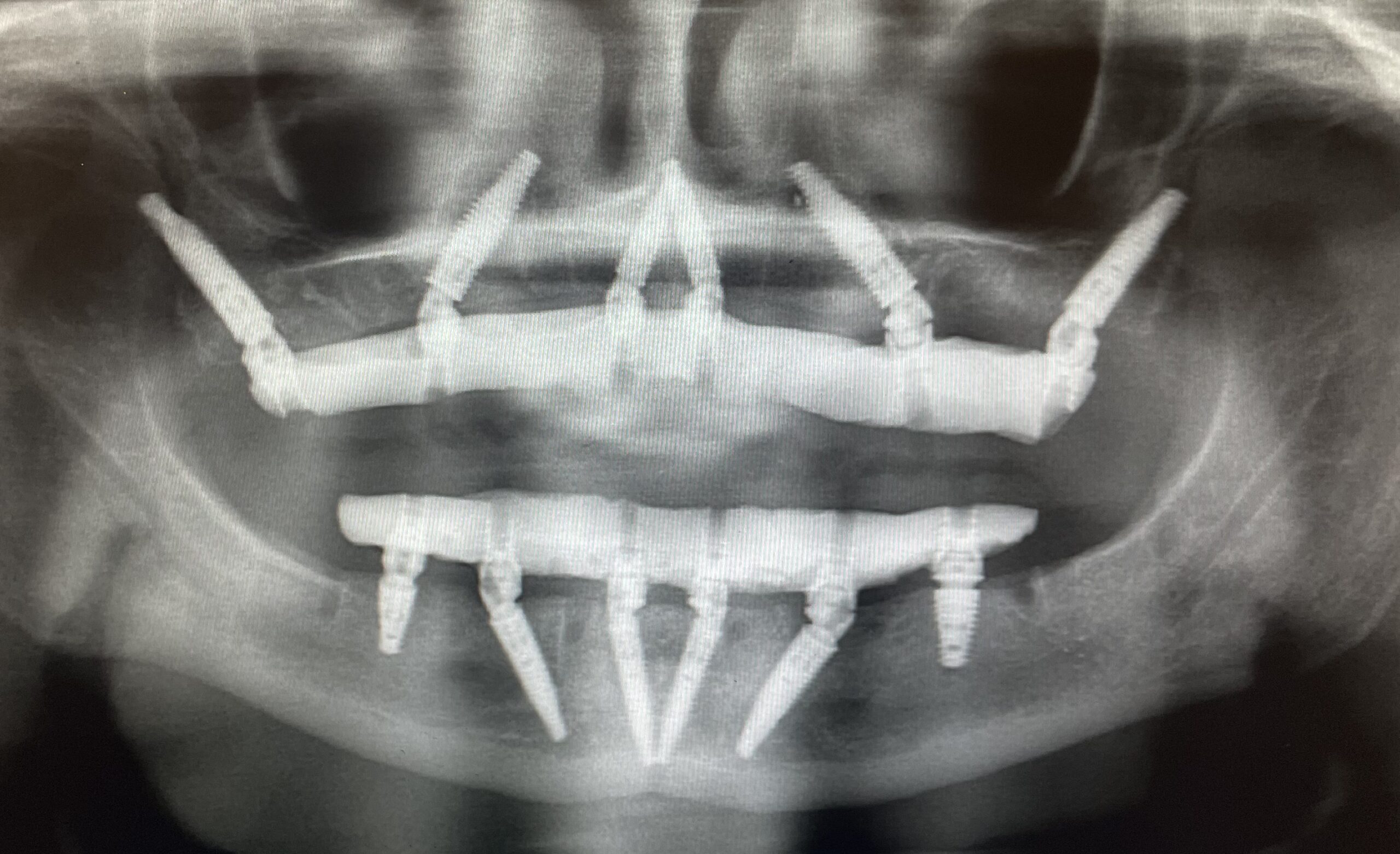 Dental Implant Smile Makeover Xray showing dental implants in bone and screw retained prosthesis attached